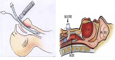 产品推荐：一次性使用气管插管和气管切开插管套件