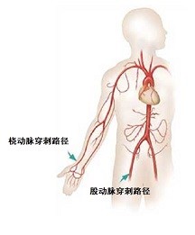 为什么越来越多的人选用桡动脉穿刺点做血管介入