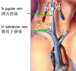 产品介绍：血液透析导管包