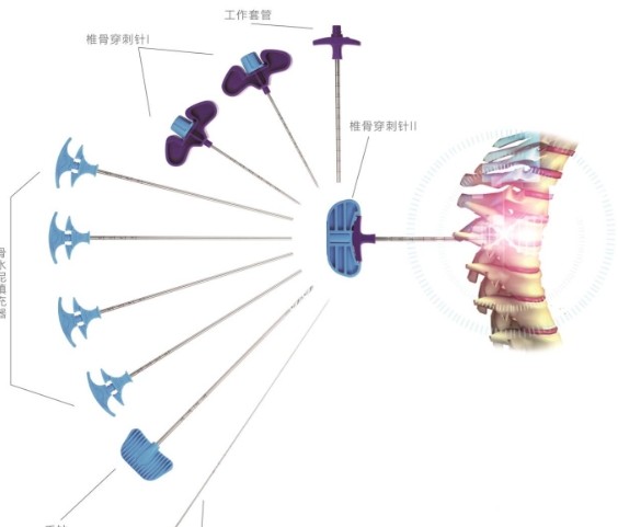 椎体成形扩张器的价格